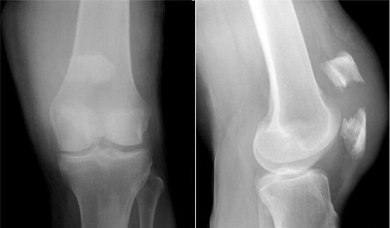 рентгенова снимка на коляното