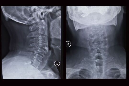 Рентгеново изображение на шийните прешлени (пациентът има остеохондроза)