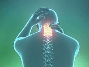 Симптом на цервикална остеохондроза е главоболие