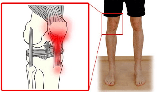 Тендинитът е възпаление на тъканта на сухожилията, което причинява болка в колянната става. 