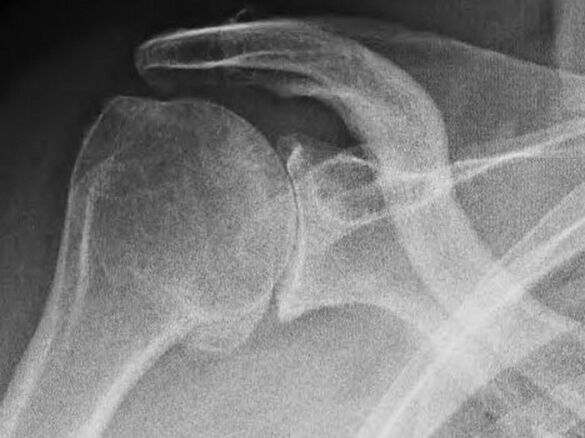 Рентгенова снимка на раменна става, засегната от артроза