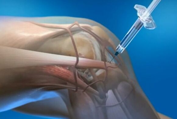 вътреставно инжектиране при артроза на колянната става