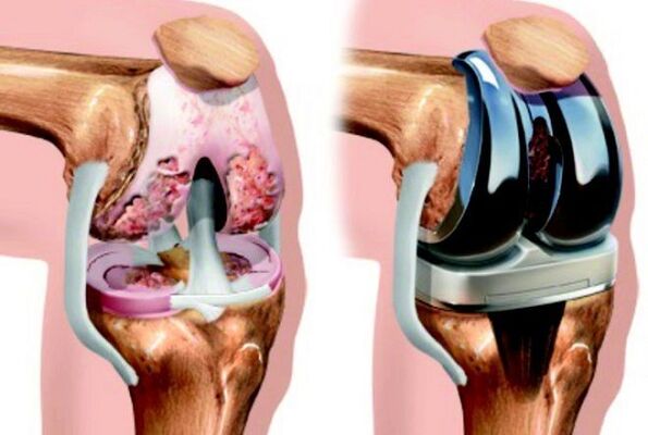 преди и след артроза на колянната става за артроза